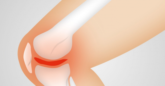 Considering Knee Replacement Surgery? image