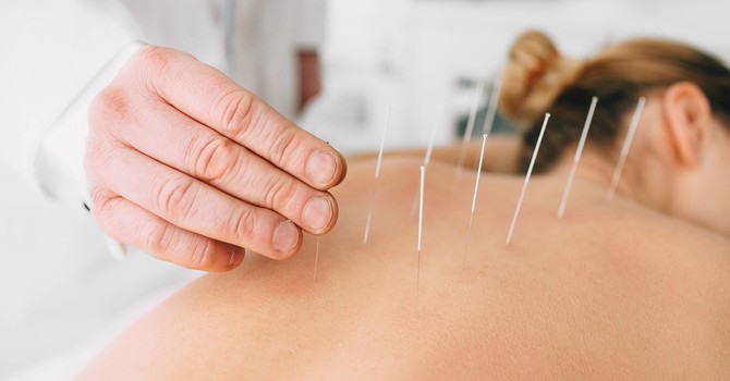Acupuncture